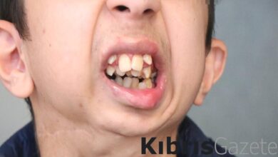 samsunda kemik problemleri yasiyor alt cenesi yok cxXeSr8d