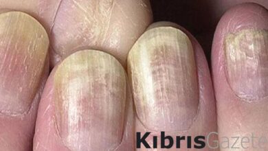 tirnaklariniz uyariyor eger tirnaklarinizda bunlar varsa hasta olabilirsiniz wUtMNE5N