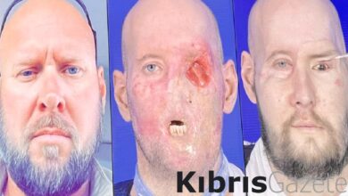 dunyada bir ilk tam goz ve kismi yuz nakli yapildi B292VfMD