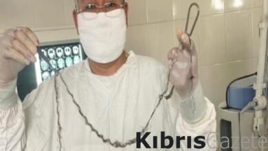 Kırgızistan'da küçük kızın 8 yıl boyunca beyninde büyüyen saçı ameliyatla alındı 6 kirgizistanda kucuk kizin 8 yil boyunca beyninde buyuyen saci ameliyatla alindi 4QRjK534
